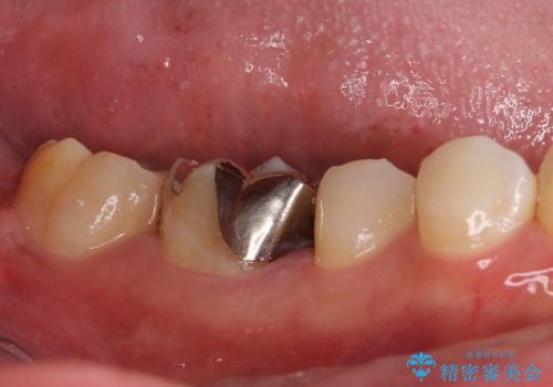 奥歯の目立つ銀歯をオールセラミッククラウンにの治療前