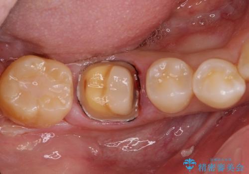 奥歯の目立つ銀歯をオールセラミッククラウンにの治療中