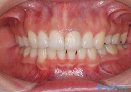 気になる口元をきれいに　前歯と奥歯のセラミック治療の治療後