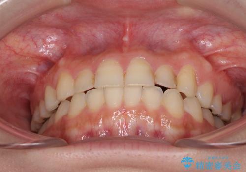 インビザラインによる前歯のでこぼこ改善の治療後
