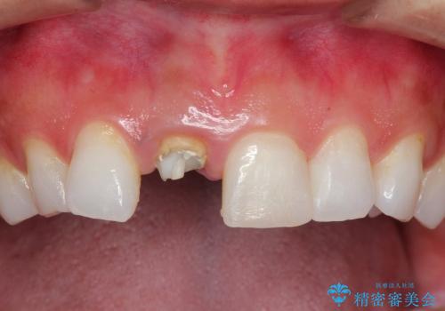 前歯の破折→前歯のセラミック治療(土台ごとやり変え)