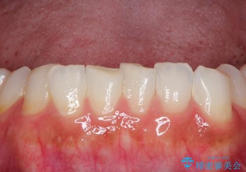 前歯の破折→前歯のセラミック治療(土台ごとやり変え)の治療前