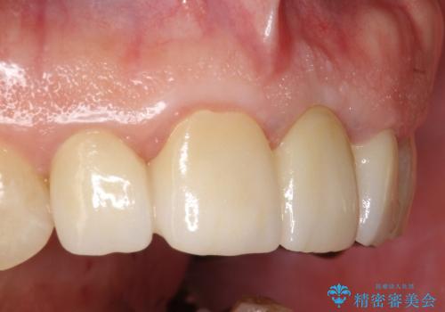 50代男性　前歯の審美ブリッジ　骨の厚みを保存した抜歯の治療後