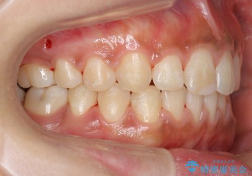 抜かない矯正　すきっ歯　前歯が欠けた　右上奥歯を後ろに下げて治療の治療後