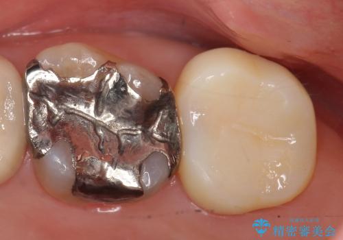 強く痛む歯の根管治療および補綴治療の治療前