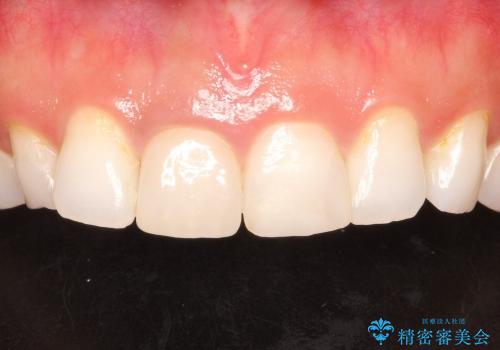前歯の破折→前歯のセラミック治療(土台ごとやり変え)の治療後
