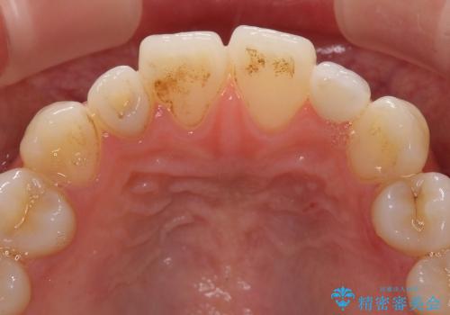 小さい歯をきれいにしたい　矮小歯のセラミック治療の治療後