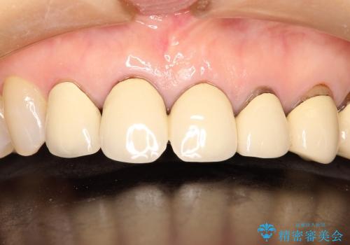 歯の根元が黒いのが気になる　セラミックによる再補綴での改善の治療前