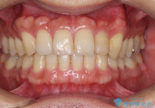 前歯の軽度のでこぼこをインビザライン　ライトで改善の治療後