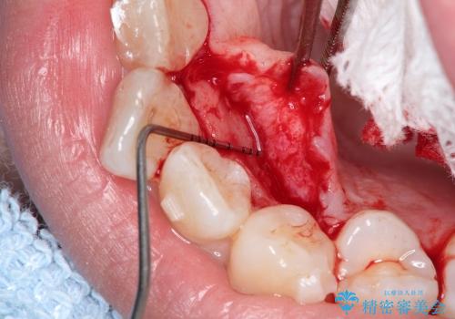 正中過剰埋伏歯の抜歯の治療中