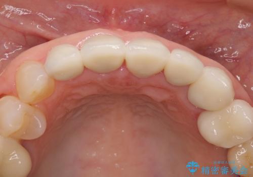 歯の根元が黒いのが気になる　セラミックによる再補綴での改善の治療後