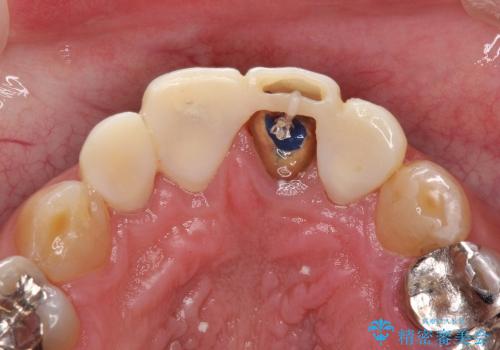 50代男性　前歯の審美ブリッジ　骨の厚みを保存した抜歯の治療中
