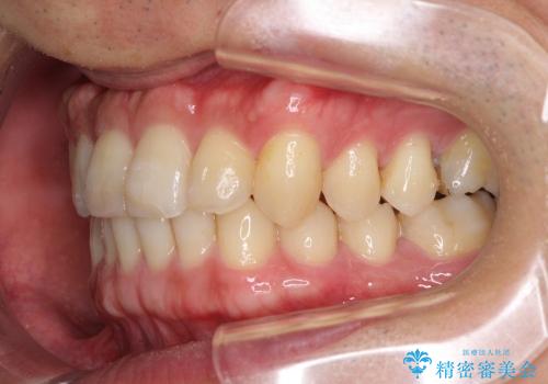 前歯の軽度のでこぼこをインビザライン　ライトで改善の治療後