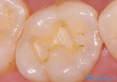 水銀を含む環境汚染金属アマルガムの除去 奥歯のセラミックインレー修復の治療中