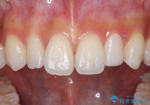 小さい歯をきれいにしたい　矮小歯のセラミック治療の治療中