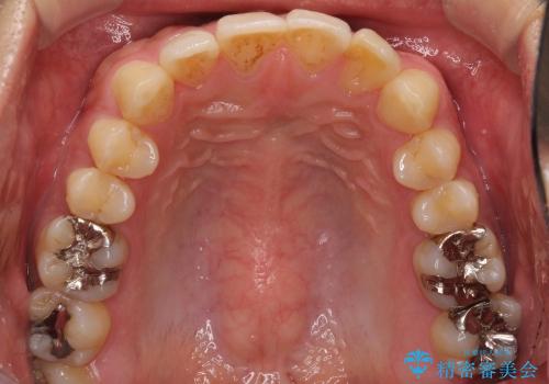 前歯の軽度のでこぼこをインビザライン　ライトで改善の症例 治療後