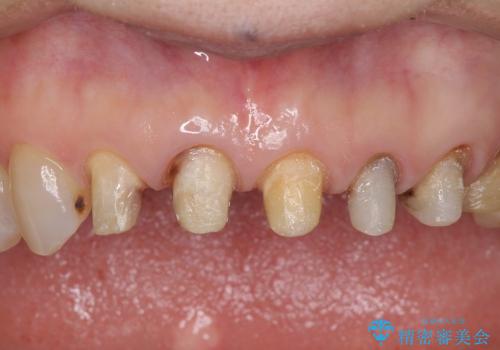 歯の根元が黒いのが気になる　セラミックによる再補綴での改善の治療中