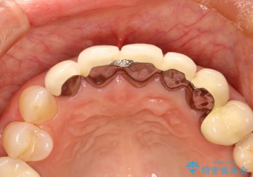 歯の根元が黒いのが気になる　セラミックによる再補綴での改善の治療前