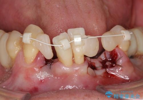 小矯正を併用し歯の神経を残す歯周病治療・下顎前歯メタルボンドブリッジの作製①の治療後