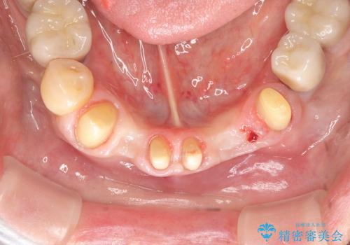 小矯正を併用し歯の神経を残す歯周病治療・下顎前歯メタルボンドブリッジの作製②の治療中