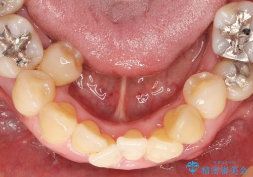 小矯正を併用し歯の神経を残す歯周病治療・下顎前歯メタルボンドブリッジの作製①の治療前