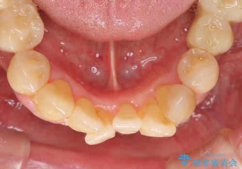 小矯正を併用し歯の神経を残す歯周病治療・下顎前歯メタルボンドブリッジの作製②の治療前