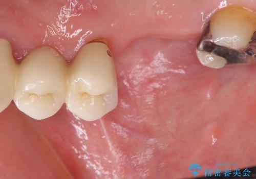 [歯周病治療] インプラント・ブリッジによる咬合機能回復の治療前