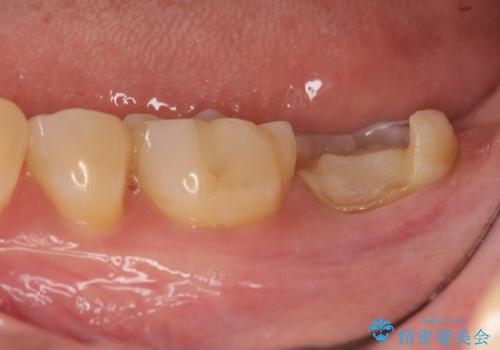 高強度フルジルコニアクラウンを用いたスペースの少ない下顎奥歯治療の治療前