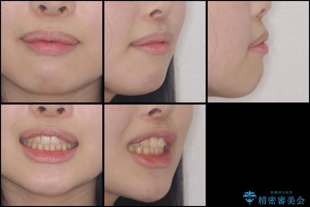 インビザラインによる前歯のでこぼこの改善の治療後（顔貌）