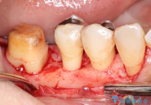 歯を残す歯周病再生治療 ① (再生治療・歯周ポケット除去)