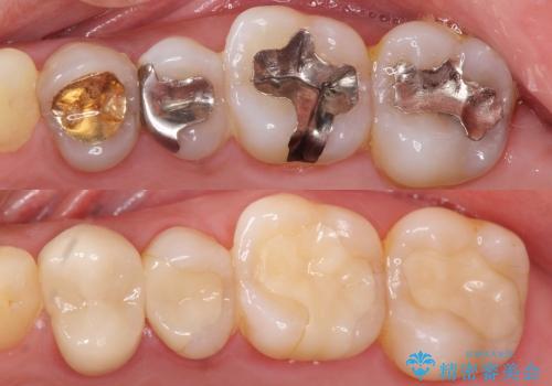 [メタルフリー治療]  銀歯を白く emaxを用いた審美修復・補綴
