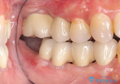歯を残す歯周病再生治療 ② (歯根分割・歯周補綴)の治療後
