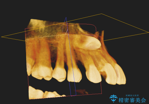 矯正治療に伴う犬歯埋伏抜歯