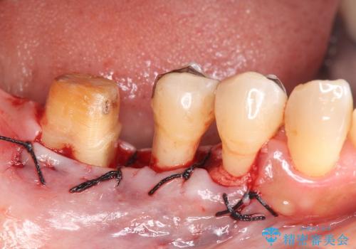 歯を残す歯周病再生治療 ① (再生治療・歯周ポケット除去)の治療後