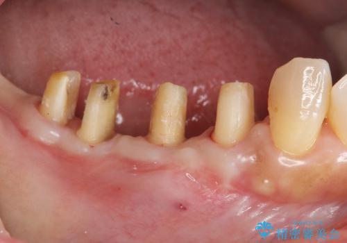 歯を残す歯周病再生治療 ② (歯根分割・歯周補綴)の治療中