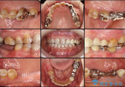 歯の悩みを一気に解決　総合歯科診療の治療前