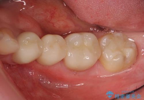 見える銀歯を白く　下顎セラミックブリッジ治療の治療後