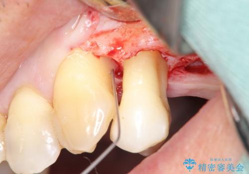 [歯周病治療①] 再生療法→歯周ポケット除去→歯周補綴の治療中