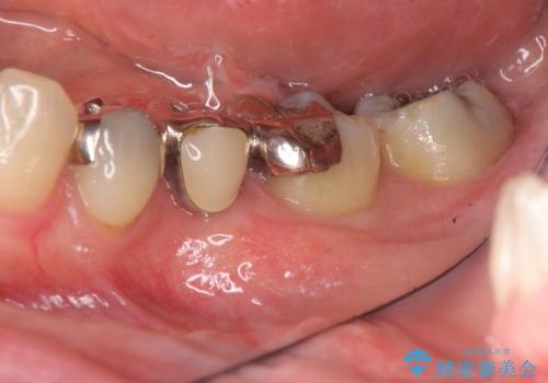 見える銀歯を白く　下顎セラミックブリッジ治療の治療前