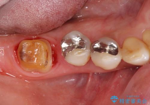 歯を残す歯周病再生治療 ② (歯根分割・歯周補綴)の治療前
