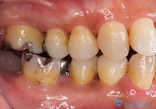 歯を残す歯周病再生治療 ① (再生治療・歯周ポケット除去)の症例 治療前