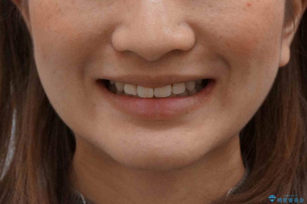 20代女性　八重歯をきれいにの治療後（顔貌）