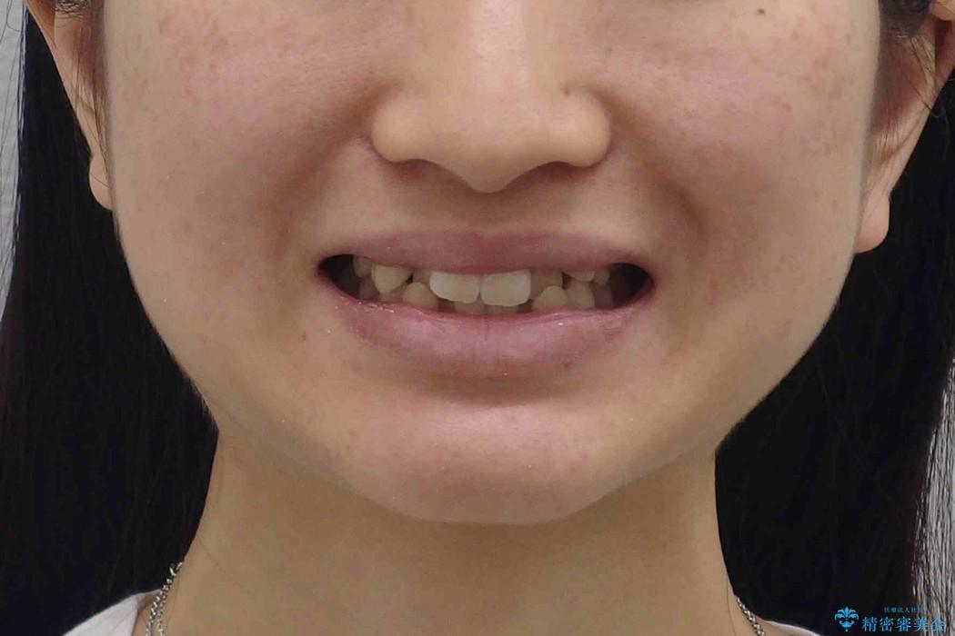 20代女性　八重歯をきれいにの治療前（顔貌）