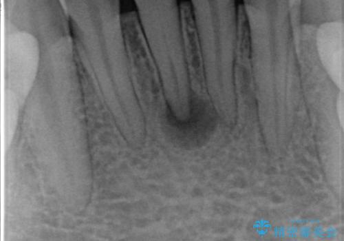 下の前歯　精密根管治療の症例 治療前