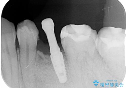 乳歯の晩期残存　永久歯がない　矯正とインプラントによる治療の治療中