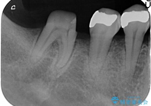 歯を残す歯周病再生治療 ① (再生治療・歯周ポケット除去)の治療前