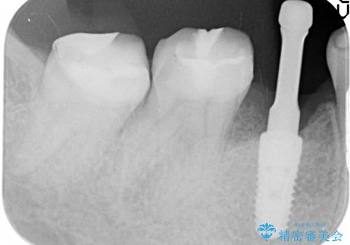 乳歯の晩期残存　永久歯がない　矯正とインプラントによる治療の治療中