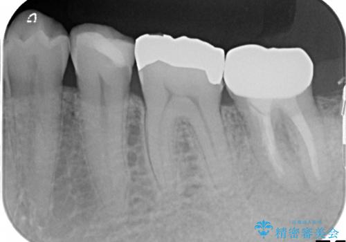40代男性　痛む奥歯の原因療法　の治療後