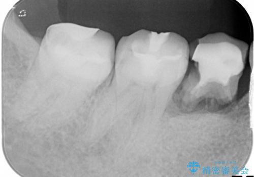 乳歯の晩期残存　永久歯がない　矯正とインプラントによる治療