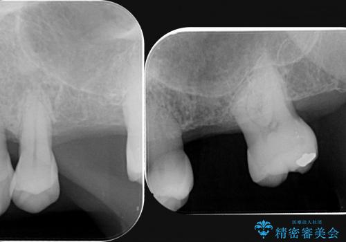 [歯周病治療①] 再生療法→歯周ポケット除去→歯周補綴の治療前